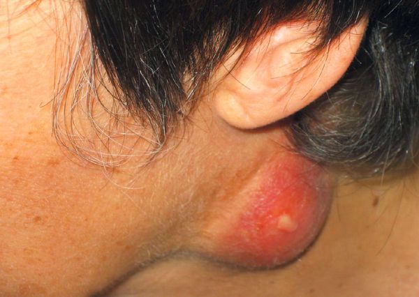 Туляремия. Основные меры профилактики